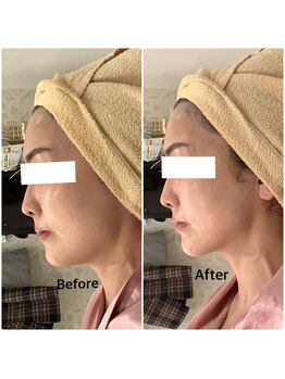 スペチアーレ 夙川/横顔も更に美しく美顔革命