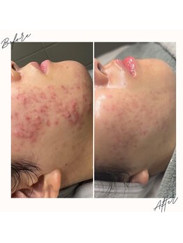 イチロクイチハチ(1618)/思春期ニキビに悩んだら