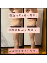 ティアメディカル(Tia Medical)/脂肪冷却5回の効果