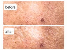 カシェット(Cachette)/50代男性COCOREGEN シミケア60分