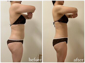 リリィブラン(Lily branc)/痩身/ブライダルエステ