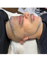 ボニータ(BONITA)/光脱毛♪