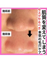 ラー(La)/毛穴ケアでモテ肌メンズへ大変身