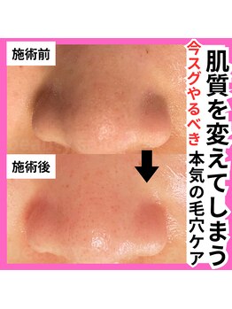 ラー(La)/毛穴ケアでモテ肌メンズへ大変身