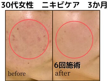 クレアス 勝どき(CREAS)/≪ニキビケア≫ハーブピーリング