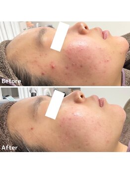 エステ ニキビケア研究所 川崎店/頬の赤み・ほほニキビケアに!