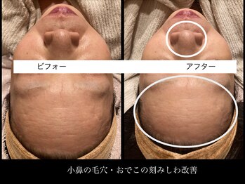 プレミアムキュア/美肌水光フォトセラピー☆