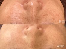 ウォーム(warm)/【肌質改善専門店warm】シミケア