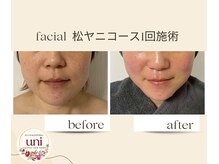パーソナル ユニ(uni)/松ヤニスタンダード1回施術