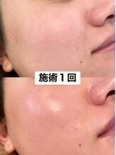 リュクスルーム(Luxe room)/韓国式ハーブピーリング１回