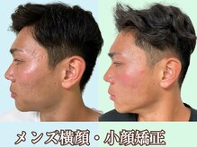 ナチュラルパーフェクトフェイス 新宿/横顔の印象を◎/新宿駅小顔矯正
