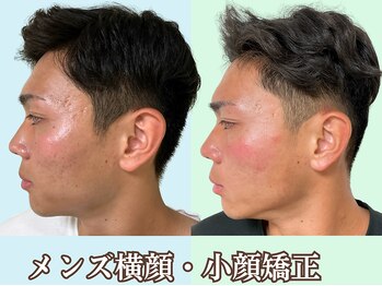 ナチュラルパーフェクトフェイス 新宿/横顔の印象を◎/新宿駅小顔矯正