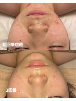 リルビー(Lilby)の写真/繰り返す肌悩みを、土台から整える肌質改善。