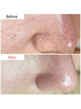 エクシア(Excia)/次世代毛穴洗浄