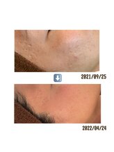 アイリス(AIRIS)/凹凸のある肌に！