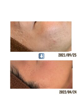 アイリス(AIRIS)/凹凸のある肌に!