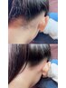 【横顔美人】もみあげ＋うなじ脱毛、全方位どこから見られても◎