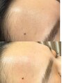ストーリー 小田原(STORY)&nbsp;おでこWaxでうぶ毛を除去！ツヤツヤおでこ美人になれます！