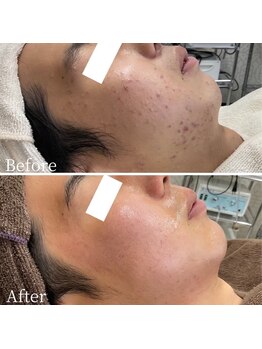 エステ ニキビケア研究所 川崎店/メンズニキビでお悩みの方へ