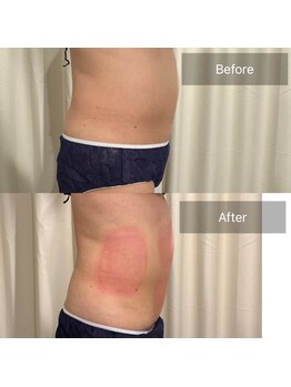 ティープラス 大和鶴間店(T-PLUS)/脂肪冷却痩身/ビフォーアフター