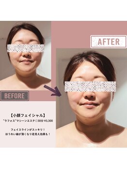 マーリエ(Malie)/【ラフォス】小顔リフトアップ