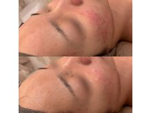 ラドンナ(LA DONNA)/赤み