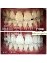 ホワイトニングサロン 広島店/【ホワイトニング施術例】