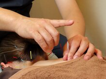 上野毛駅前整骨院 鍼灸院/鍼施術