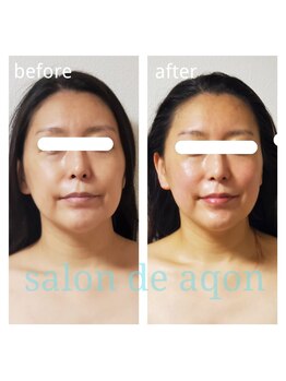 サロンドアクオン(salon de aqon)/絶対外せない小顔矯正