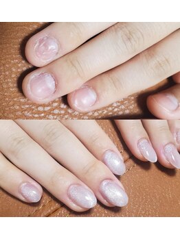 ギャラリー(Gallery)/深爪矯正before&after