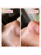 ランプ(Lampe)/◇ハイドラピーリングとプラズマ