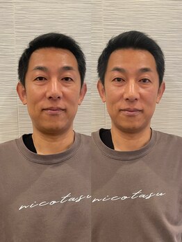 長寿鍼灸院 長寿整骨院/men's美容鍼50本効果★