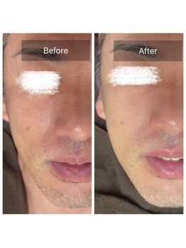 ラビ(RABBI)/40代男性　小顔矯正