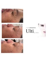 アルティ バイ ドルチェ(Ulti by dolce)/人気No.1の美肌メニュー