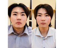リサ鍼灸院(RISA鍼灸院)の雰囲気（鬼美容鍼によるビフォーアフター☆コリを無くせば顔スッキリ♪）