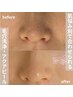 【毛穴洗浄】肌診断+毛穴洗浄・アクアピール+白玉パック¥12000→¥6000