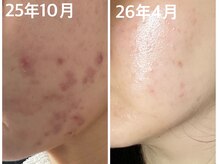 ナオフクオカ ヒーリングフォースエヌ(NaoFukuoka/healingforceN)/ホルモンの乱れからの肌荒れ