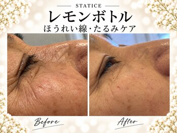 スターティス 麻布十番店(STATICE)の写真/【脂肪分解☆レモンボトル導入店】レモンボトル×小顔矯正同時施術でタイパ◎忙しい方におすすめ！