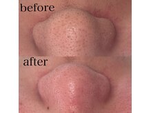 アイシェリー(eyecherie)/毛穴エクストラクション