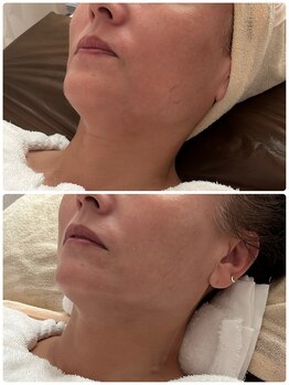 ナナプラス(nana plus)/リフトアップケア