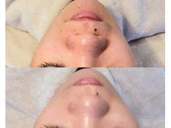 ムーフ(Moof)/施術例