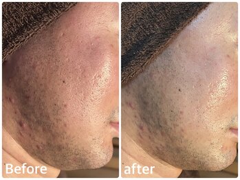 ボヌールデソワ(Bonheur de Soi)/ハーブピーリング/赤み軽減/堀江