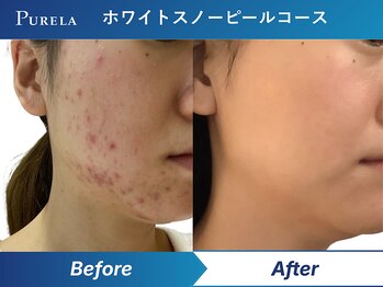 ピュアラ 心斎橋店/大人気ホワイトスノーピール