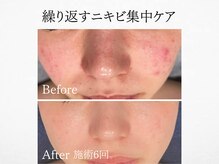 アンドミルル(and Milulu)/【繰り返すニキビ集中ケア】