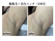 レビア(REVIA)/脇脱毛＋美白パック〈1回目〉