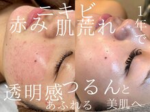 ルーツリー(Rootree)の雰囲気(肌質改善を1年間継続。ハーブピーリングで毛穴・赤み軽減)
