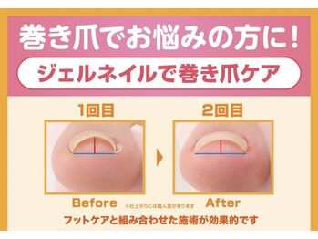 ブレスネイル(brace Nail)の写真/足元から綺麗に♪フットケアで乾燥しない美しい足元を！たしかな施術で巻き爪でお悩みの方にも◎[表参道]