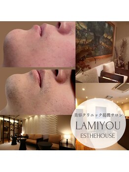 ラ ミュー エステハウス 松阪店の写真/男性もツルスベ肌で好印象に☆髭剃りが面倒な方、髭剃り負けしてしまう敏感肌の方にもオススメです!!