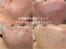 コットンビューティ(cotton.beauty)の雰囲気（辛いニキビで悩むのは最後にしませんか？？最後のニキビケアに!）
