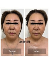 コリオ(KoRiO)/リフトアップ1回［狭山ヶ丘］